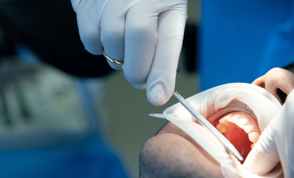 Gingivectomie : Un Guide Complet