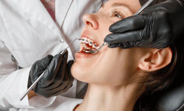 Les Broches en Métal en Orthodontie : Efficacité et Valeur