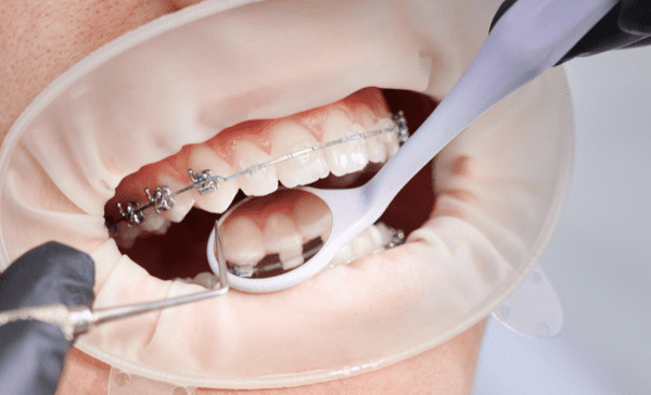 L'appareils de rétention : Guide Complet