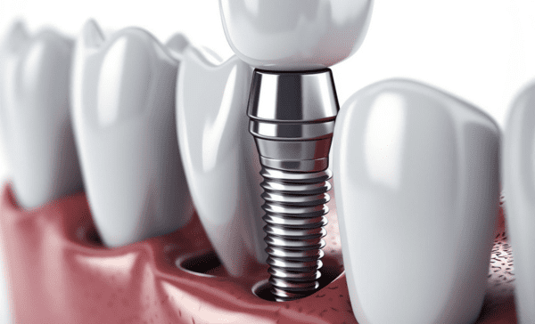 Implants Dentaires : La Solution Idéale pour un Sourire Parfait ?